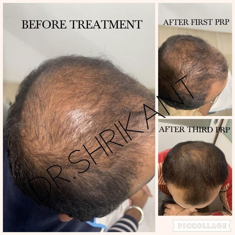 PRP hair treatment before, after first and third PRP