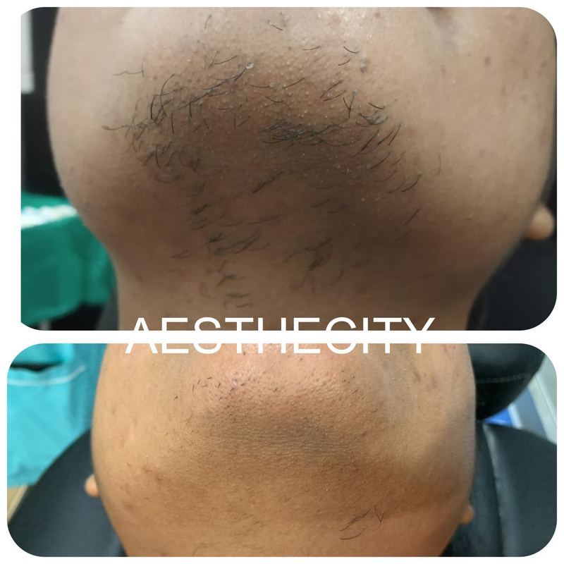 Laser hair reduction before and after