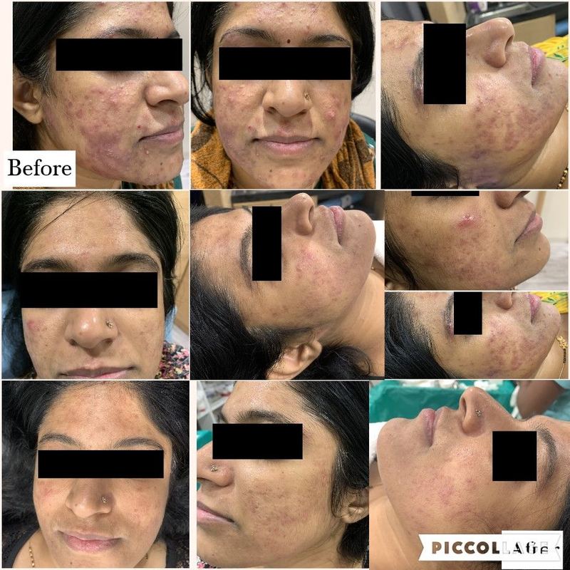 Acne treatment before and after