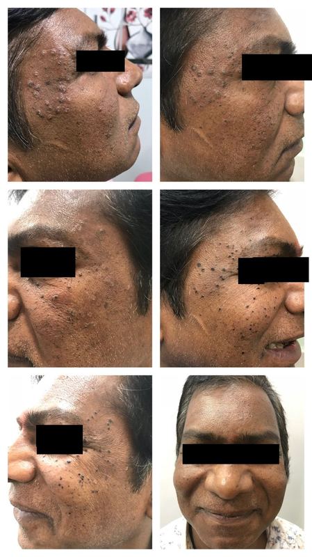 Freckles and skin lesion treatment results