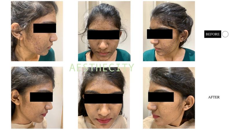 Chemical peel before and after