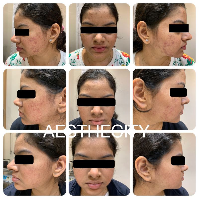 Acne and acne scar treatment results